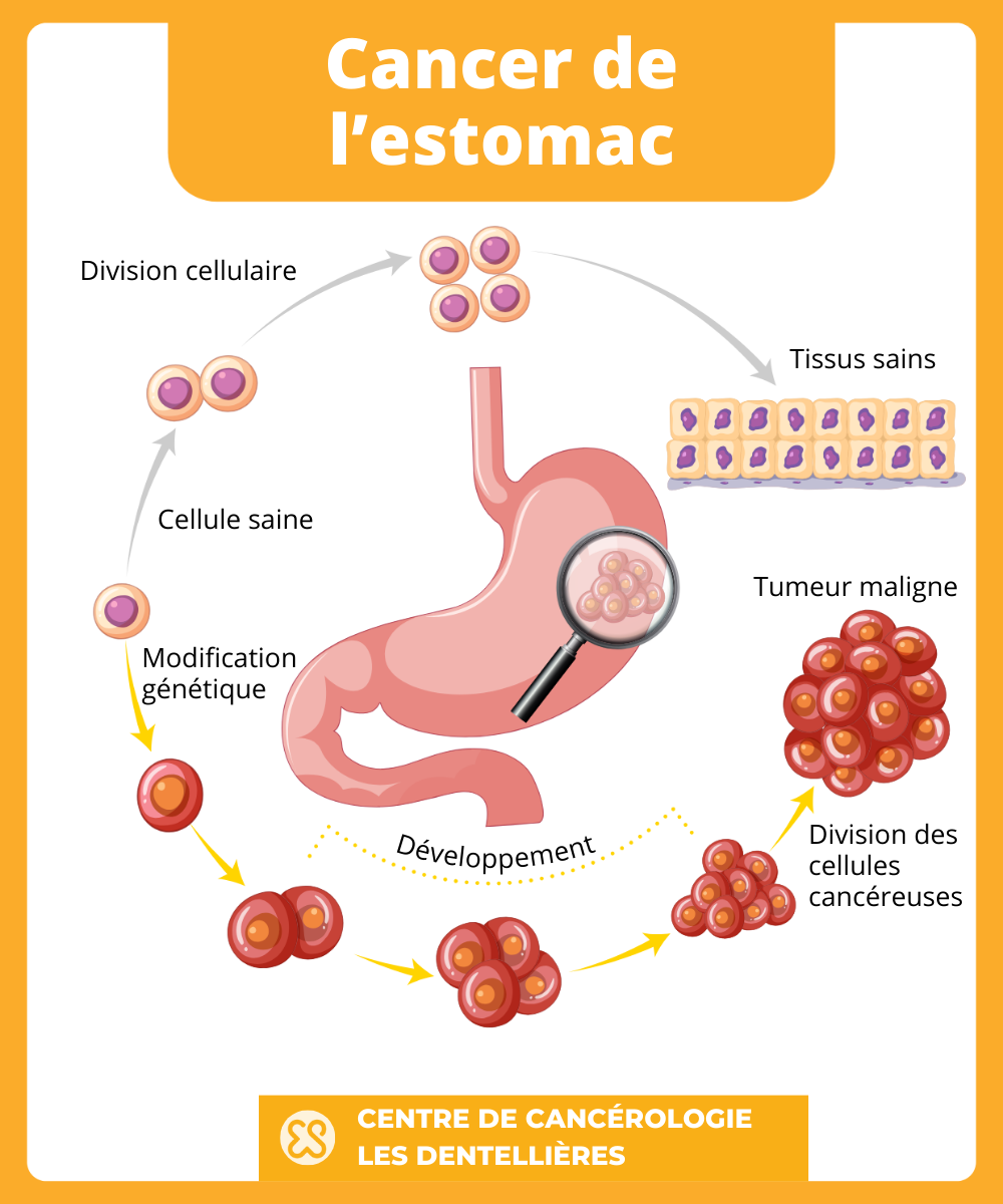 Cancer de l’estomac, les symptômes aux premiers stades — free download